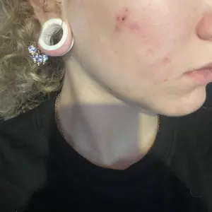 Product Review of Lion Pair Acne Cream Acne Treatment Pimples Removal Cream Pair Acne Creamy Foam Facial Wash Gentle Antibacterial from 𝕒**𝕒