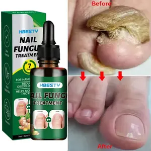 7Days Nail Fungus Treatment Serum Ginger Anti-infective Paronychia Onychomycosis Toe Foot Nail Fungal Repair Gel Hand Foot Care