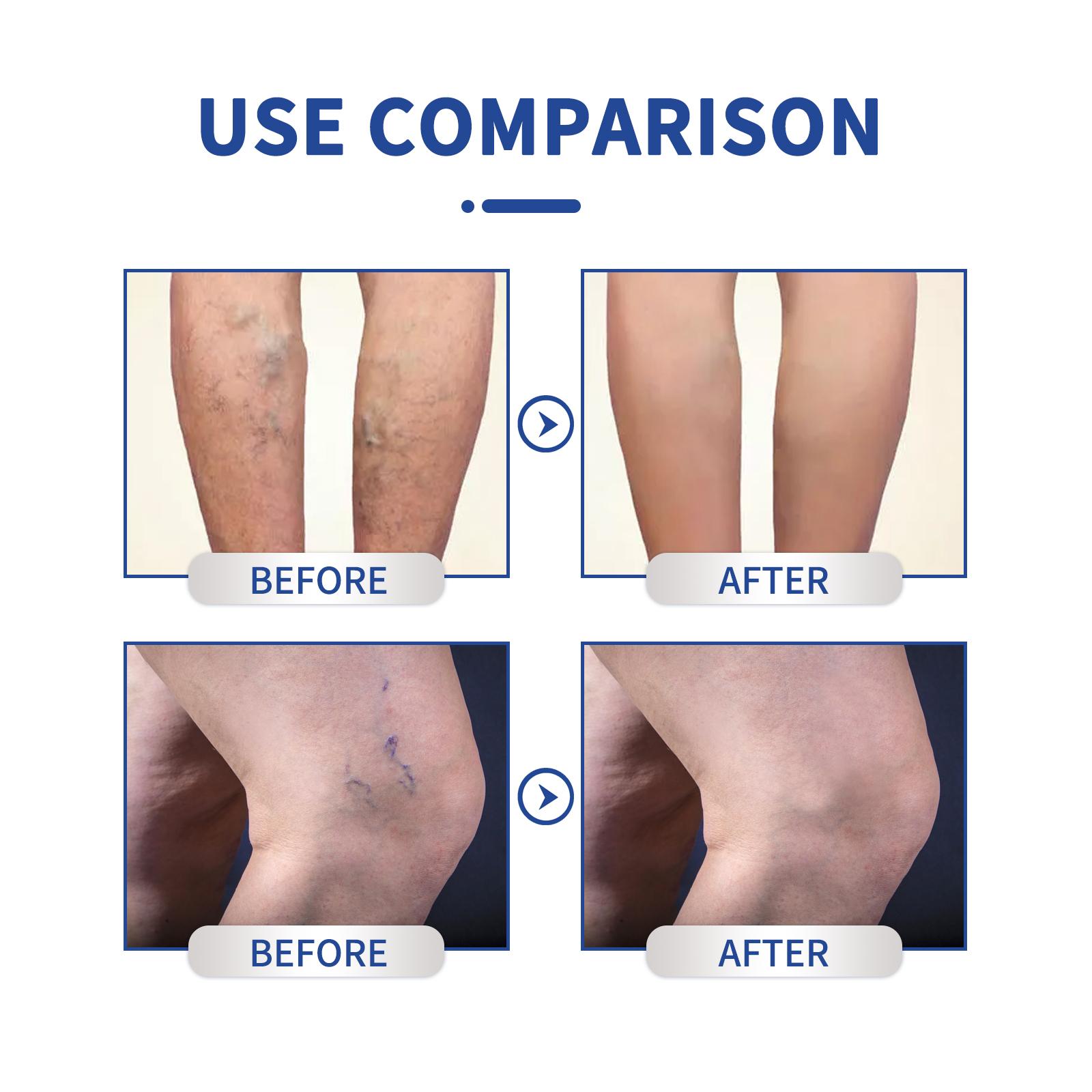 Vein Massage Varicose Cream Repair Earthworm Legs To Relieve Leg Blood Vessel Bulge And Varicoidea