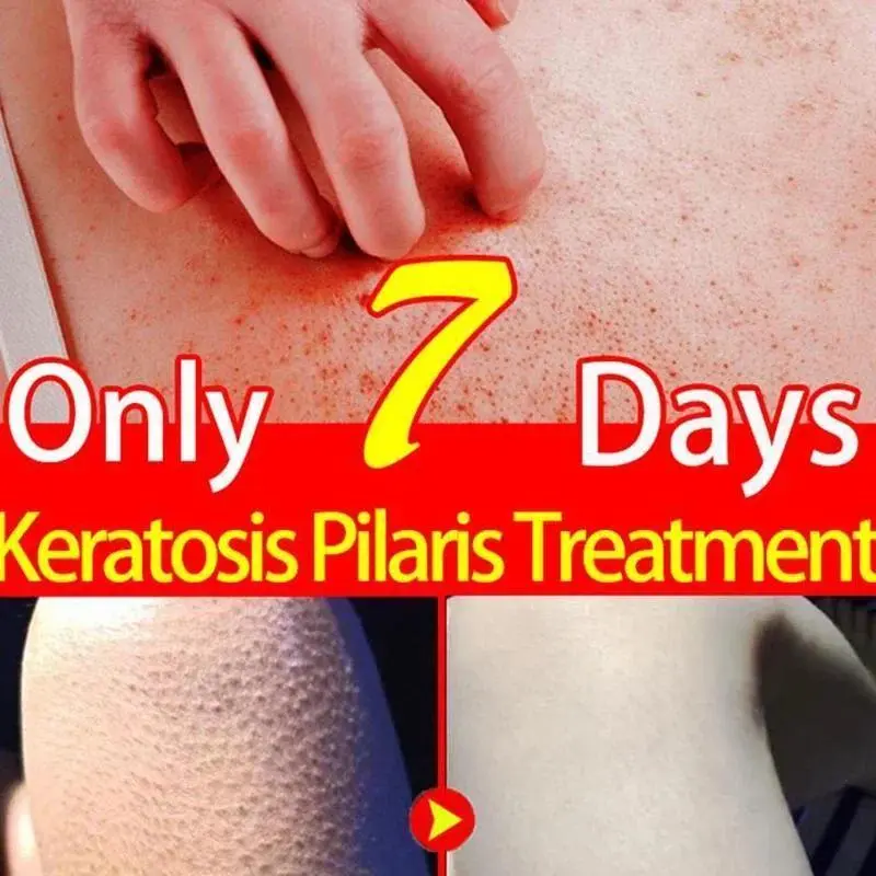 KP Bump Eraser Keratol Body Scrub - 10% AHA Exfoliating Treatment, Bikini Bump Eliminator, Impurity Remover for Keratosis Pilaris & Rough Skin, Beauty & Personal Care Body Scrub, Bikini Bump Eliminator Body Scrubs