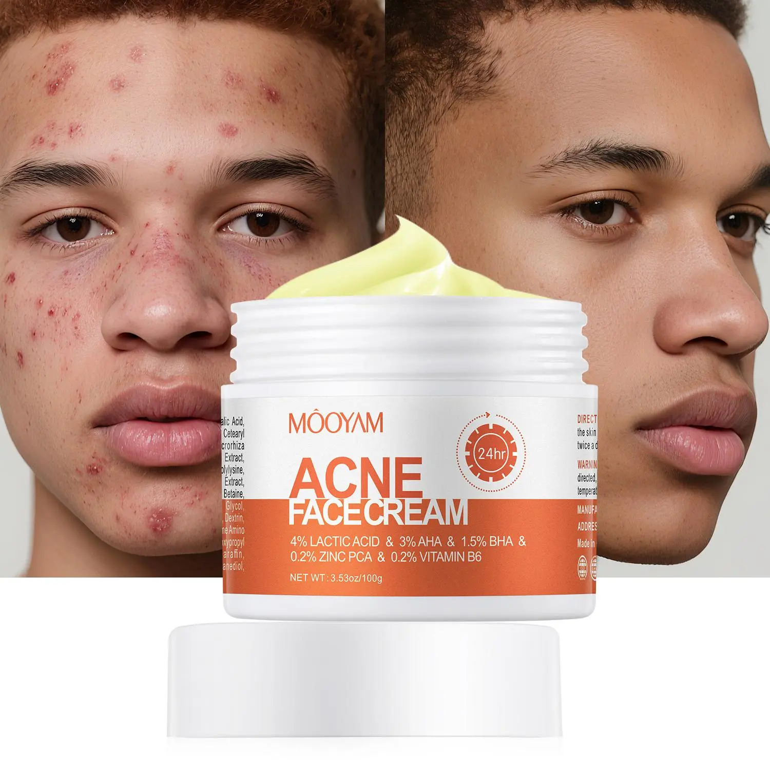 MOOYAM Acne Cream Centella & Snail Repair Cream Pimple Skincare Repair Gel