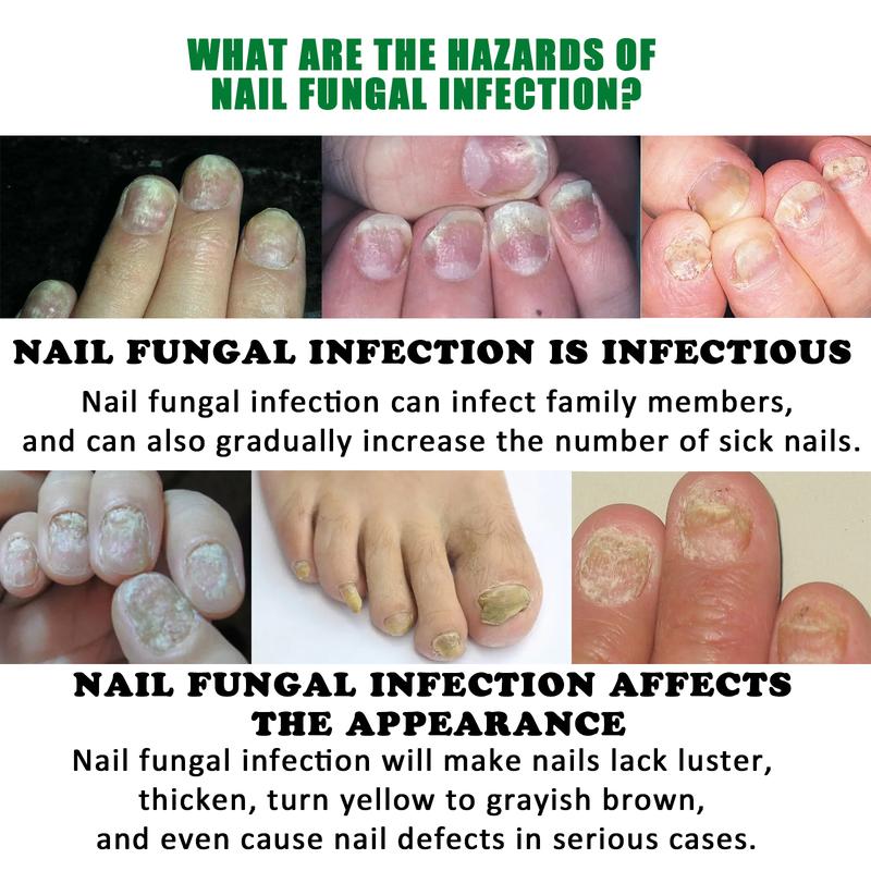 Jaysuing Ginger Nail Care Solution Gently cares for soft nails on hands and feet Smooths nail surfaces Moisturizes and brightens nails