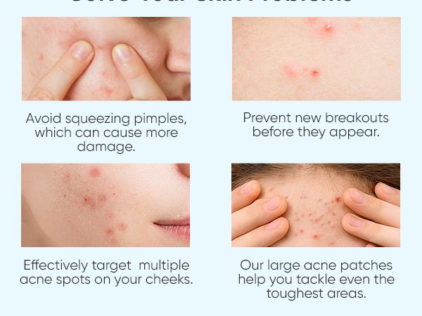 Microdart Acne Patch for Post Acne Stage - 9 Microneedle Pimple Patch and 30 Sealed Acne Patch and 96 Hydrocollooid for Dark Spots, Post-Blemish Redness and Hyperpigmentation (Pink Star) Calendula Hyaluronic