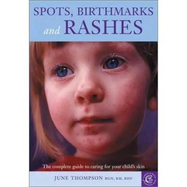 USED-Spots, Birthmarks and Rashes: The Complete Guide to Caring for Your Child's Skin by June Thompson RGN  RM  RHV (Paperback)