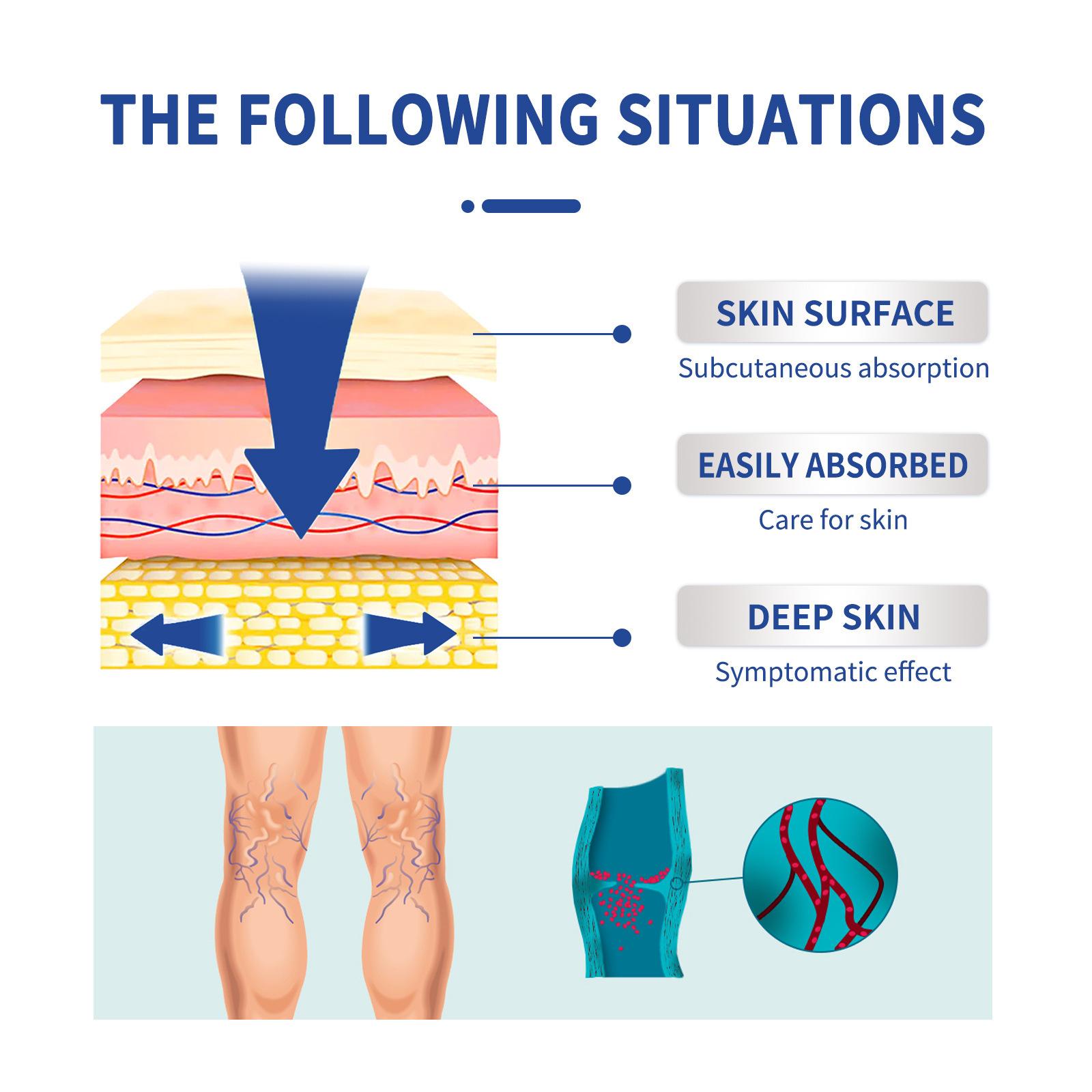SOL LORA Varicose Veins Cream for Varicose Veins Relief of Bulging Blood Vessels in Legs - Hydrating Moisturizer for Smoother Skin & Improved Circulation