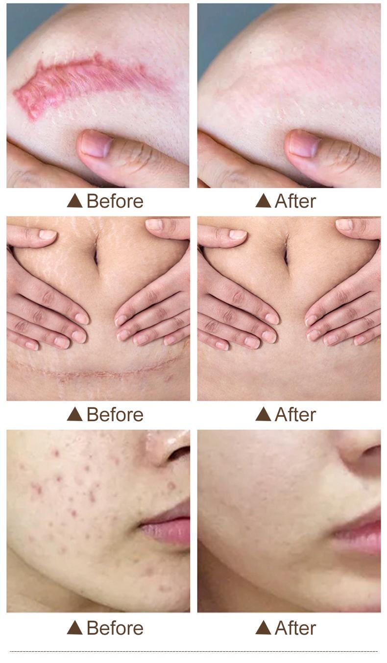 FATAZEN Acne Scar Repair Cream Centella Asiatica Fade Scars, Acne Marks, Brightens Skin Tone Skin Repair Skincare FATAZEN Acne Scar Repair Cream Centella Asiatica Fade Scars, Acne Marks, Brightens Skin Tone Skin Repair Skincare