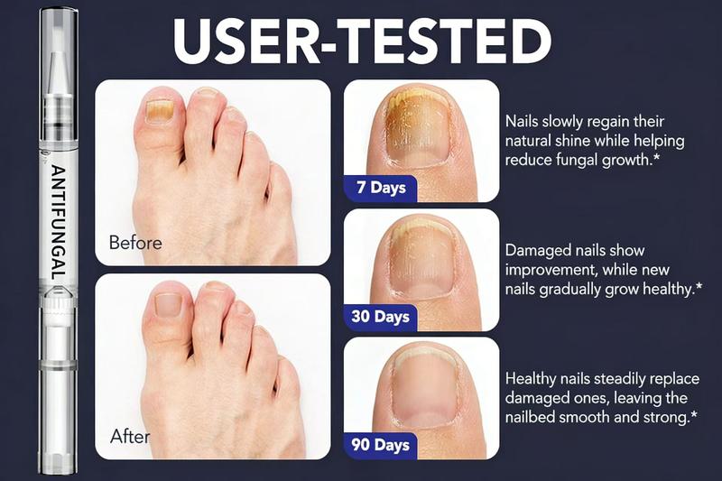 抗真菌护理笔 – 适用于受损指甲和足部真菌感染指甲，含25%十一烯酸和茶树油，强效趾甲真菌修复笔