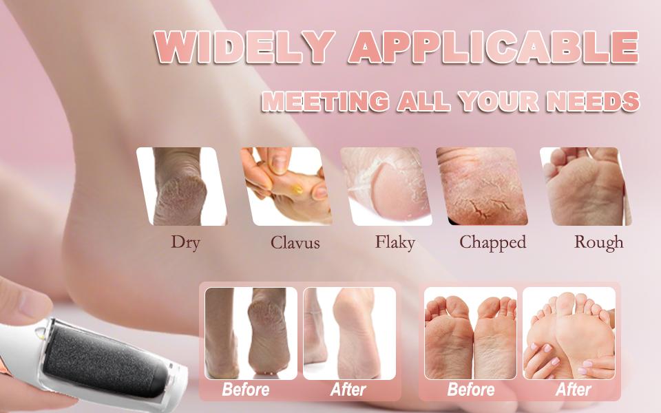 LQT Rechargeable Electric Foot File - Professional Pedicure Tool for Dead Skin, Hard Skin, Cracked Heels, with LED Light & 2 Grinding Heads