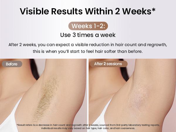 Laser Hair Removal Ice Cooling, Painless IPL Laser Hair Removal Device At-Home Permanent ipl device Portable IPL Smooth Comfort IPL Hair hair remival