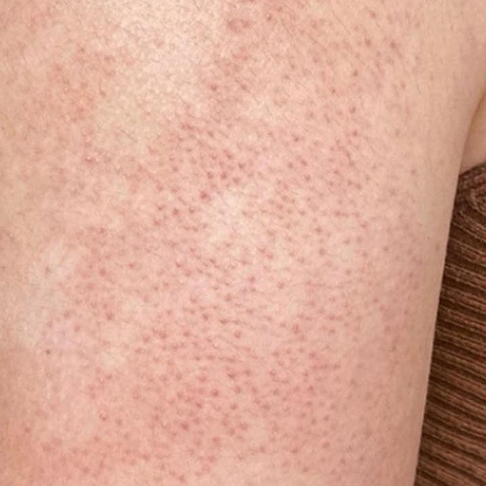 KP Bump Eraser Body Scrub 10% AHA Fresh Strawberry