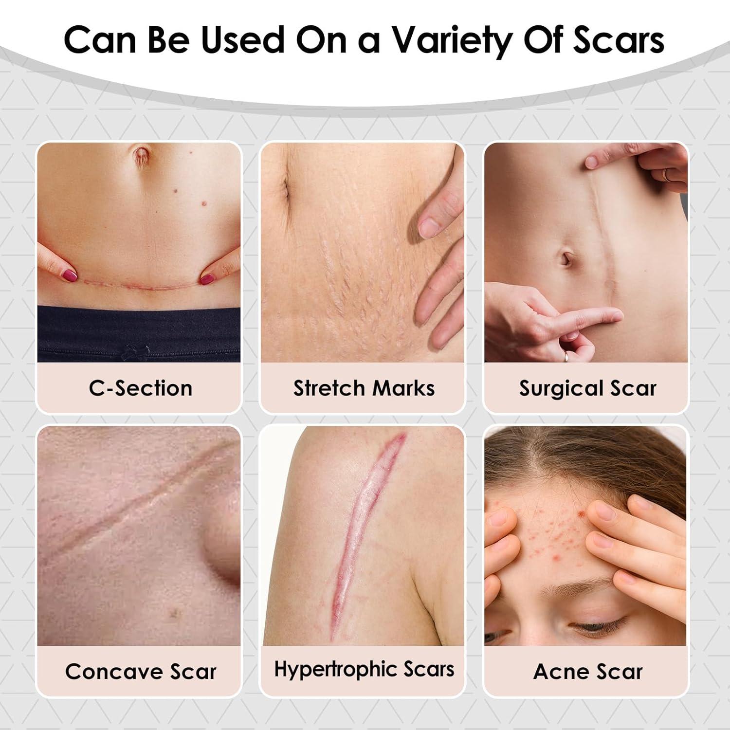 Silicone Scar Sheets,Silicone Scar Tape for Removal Treatment,Medical Grade Scar Tape for Surgical Scars,C-Section,Tummy Tuck,Scar Removal Away(1.6" x 60" Roll - 1.5M)