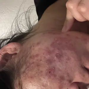 Product Review of Lion Pair Acne Cream Acne Treatment Pimples Removal Cream Pair Acne Creamy Foam Facial Wash Gentle Antibacterial from J**g **