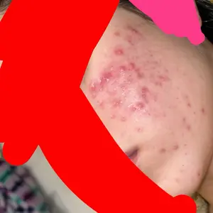 Product Review of Lion Pair Acne Cream Acne Treatment Pimples Removal Cream Pair Acne Creamy Foam Facial Wash Gentle Antibacterial from j**ꪆ