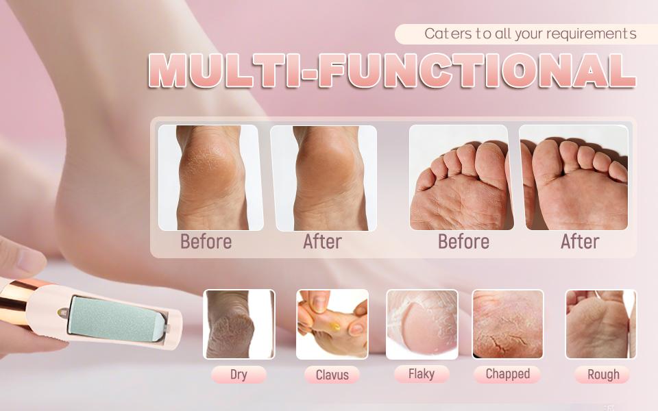 LQT Rechargeable Electric Foot File - Professional Pedicure Tool for Dead Skin, Hard Skin, Cracked Heels, with LED Light & 2 Grinding Heads