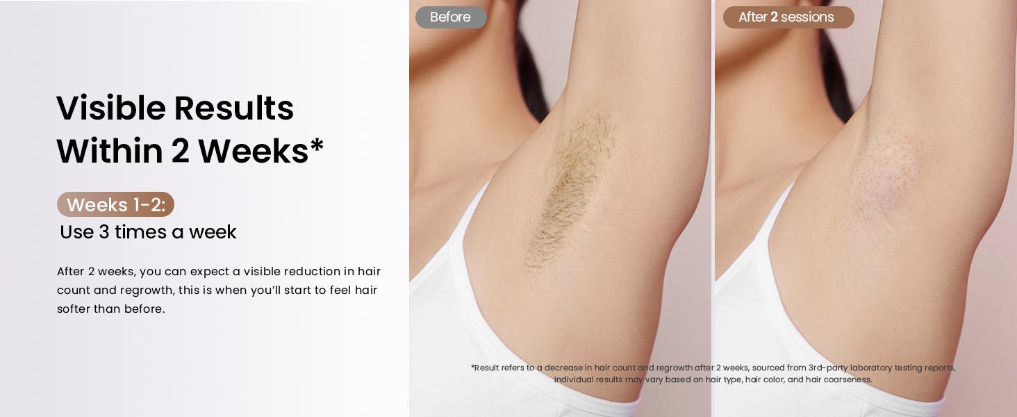 Laser Hair Removal Ice Cooling, Painless IPL Laser Hair Removal Device At-Home Permanent ipl device Portable IPL Smooth Comfort IPL Hair hair remival