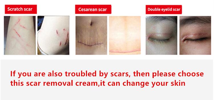 Professional and powerful scar removal gel - suitable for scar removal treatment of post-operative scars, caesarean section scars, keloids, burns, acne, etc.-A Professional and powerful scar removal gel - suitable for scar removal treatment of post-operative scars, caesarean section scars, keloids, burns, acne, etc.-A