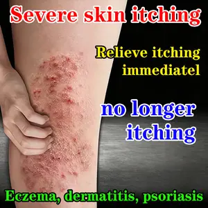Special anti-itch gel for skin itching, relieving dermatitis, eczema, psoriasis, dry skin, redness, dampness, and itching of private parts