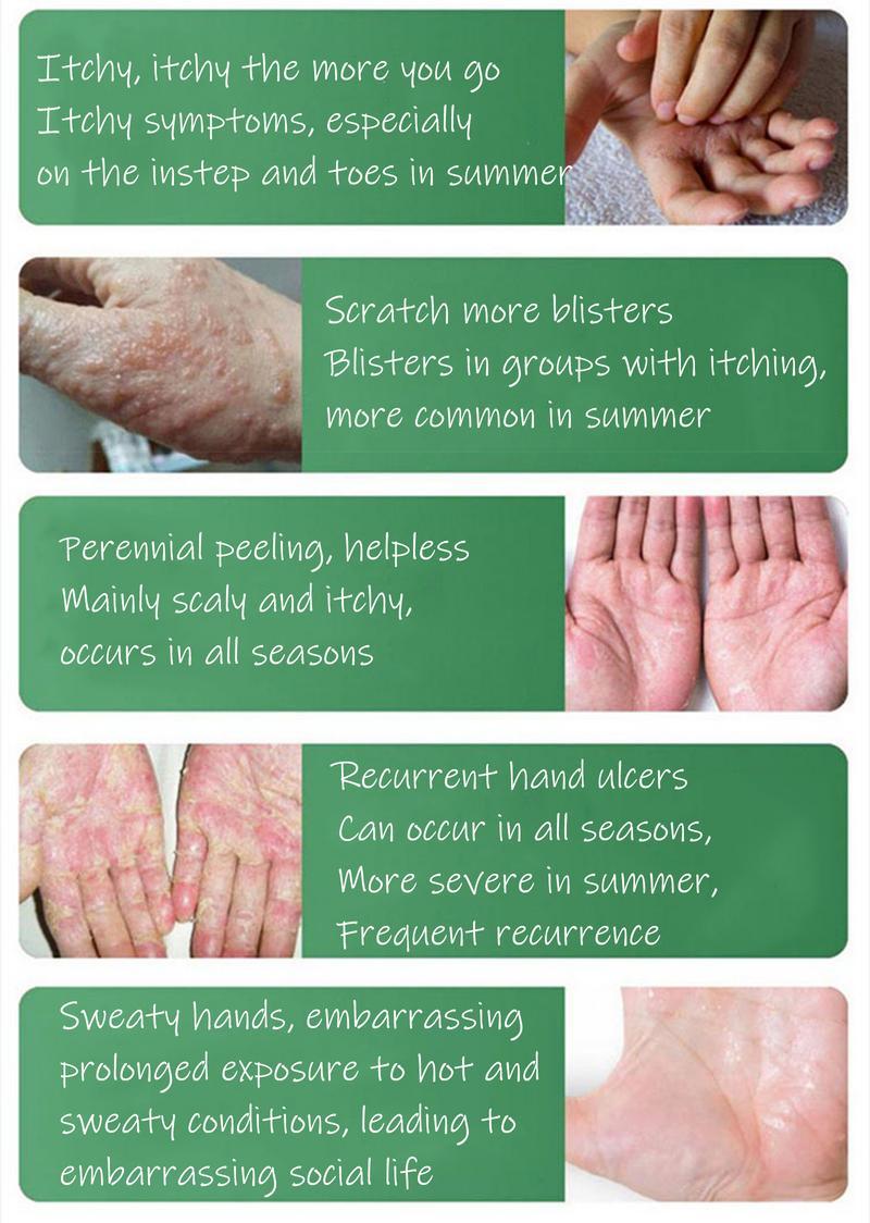 Umex All-Natural Plant-Based Herbal Relief Cream – Soothes Eczema, Psoriasis, Dry & Sensitive Skin | Ancient Botanical Formula for Whole Family Moisturizing Daily Umex All-Natural Plant-Based Herbal Relief Cream – Soothes Eczema, Psoriasis, Dry & Sensitive Skin | Ancient Botanical Formula for Whole Family Moisturizing Daily