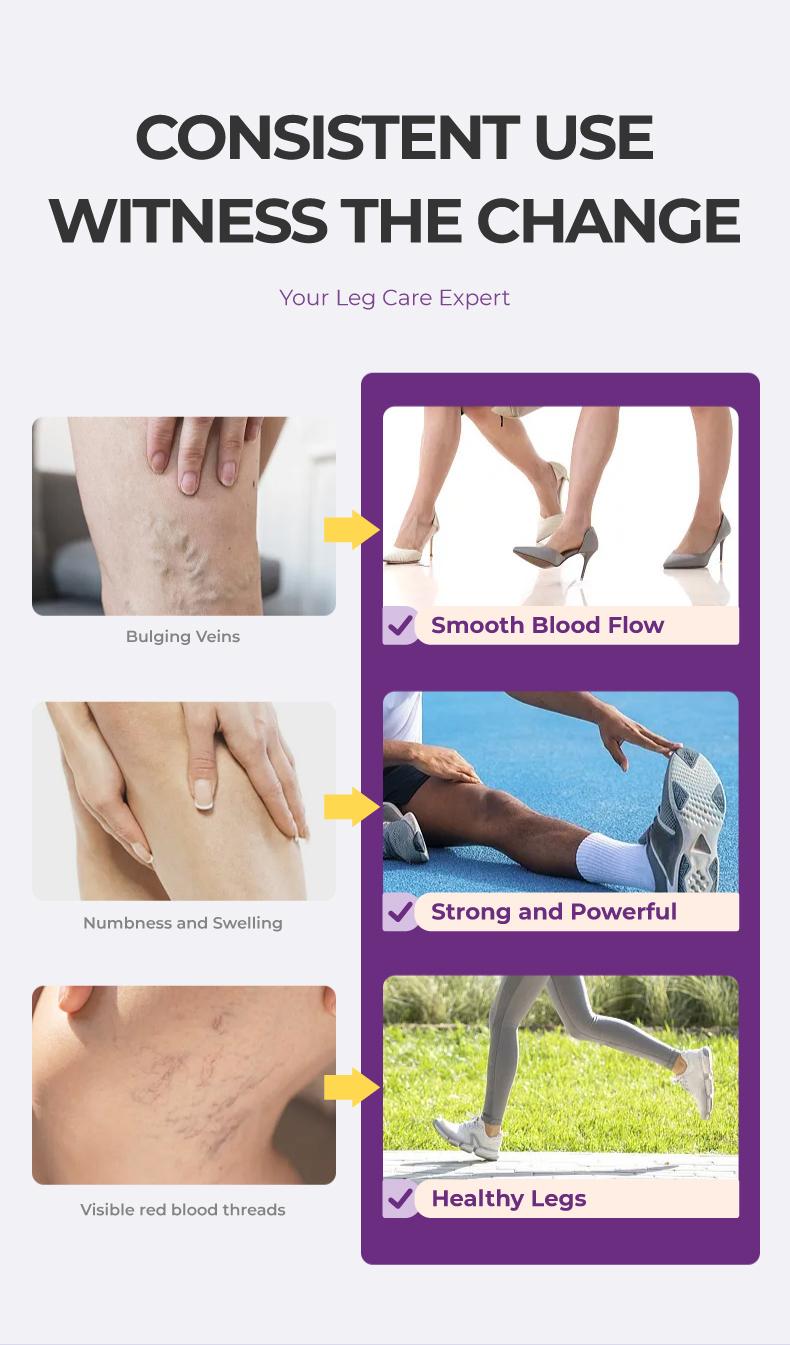 Buy 1 Free 1  Kreain Nature  Varicose Vein Treatment Cream Nature Ingredients Relieve Leg Pressure Centella Asiatica Root Extract dealsforyoudays