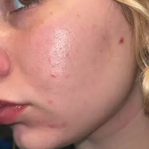 Product Review of Lion Pair Acne Cream Acne Treatment Pimples Removal Cream Pair Acne Creamy Foam Facial Wash Gentle Antibacterial from ♡**♡