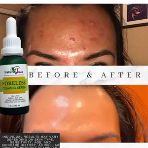 Poreless Clearing Serum 30 ml. Skincare Skin Repair Acne, No Fragrance Kojic Acid Kojic Niacinamide Comfort Brightening Daily Hydrate Papaya Radiant Smooth Soothing