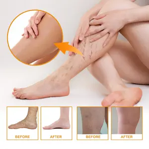 Vitamin K Cream Effective Varicose Vein Relief Cream Massage Care Relieve Leg Soreness Swelling Phlebitis Spider Pain Ointment