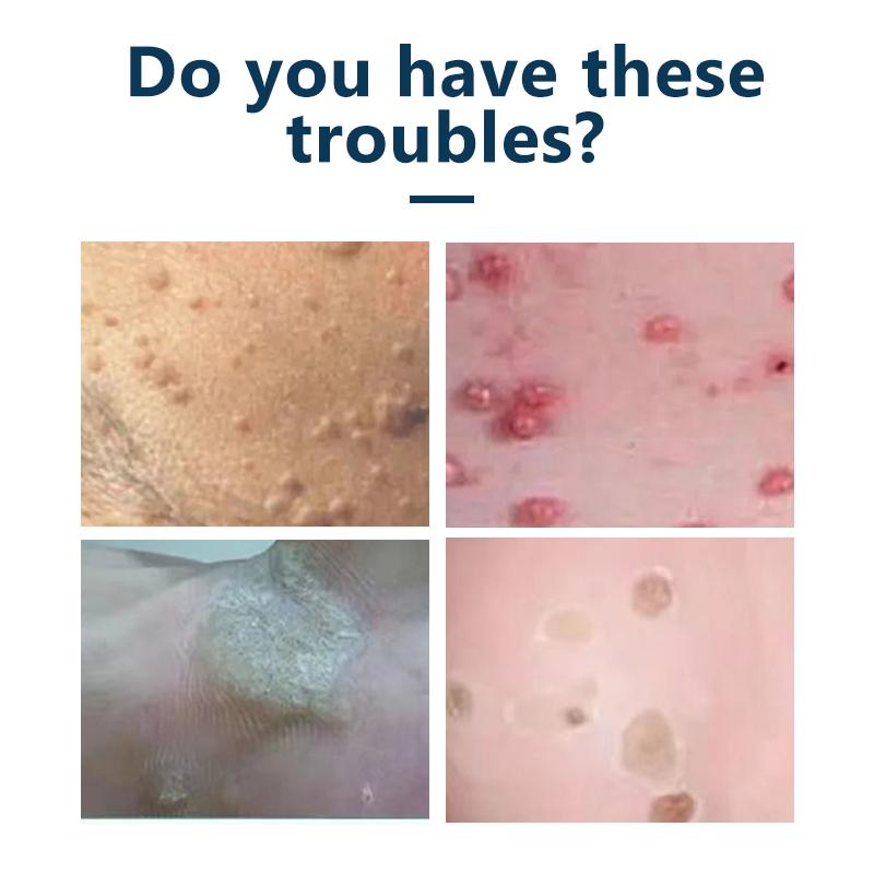 [Compatiple with OPPLII] Salicylic Acid Skin Smoothing Ointment - From  OPPLII - W_A_R_T- Skin Smoothing Ointment, 20g