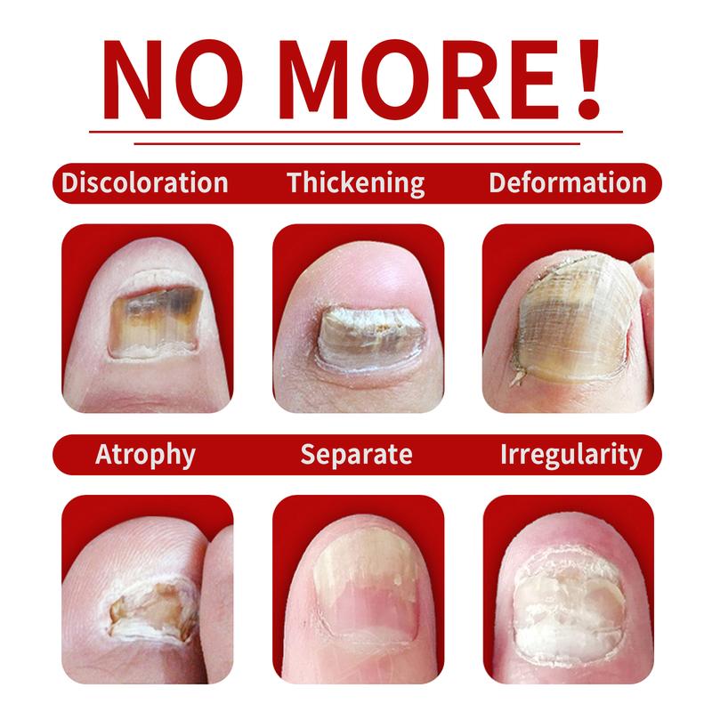 Jaysuing Ginger Nail Care Solution Gently cares for soft nails on hands and feet Smooths nail surfaces Moisturizes and brightens nails