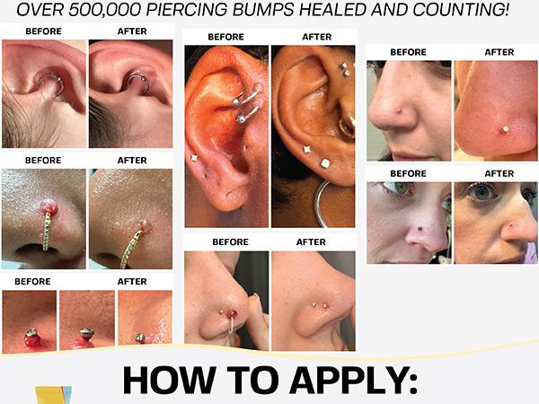 Piercing Keloid Bumps Shrinking Duo | Piercing Bump Treatment + Keloid Bump Removal Gel | Keloid Scar Removal for all Scars, Keloids & Piercing Bumps