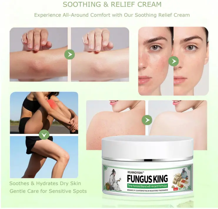 "Fungal King" — Gentle, Plant-Based Topical Care Cream for Seasonal Itching, Dryness, Cracking, and Peeling of the Feet and Body; Soothes Itching and Inhibits Bacteria