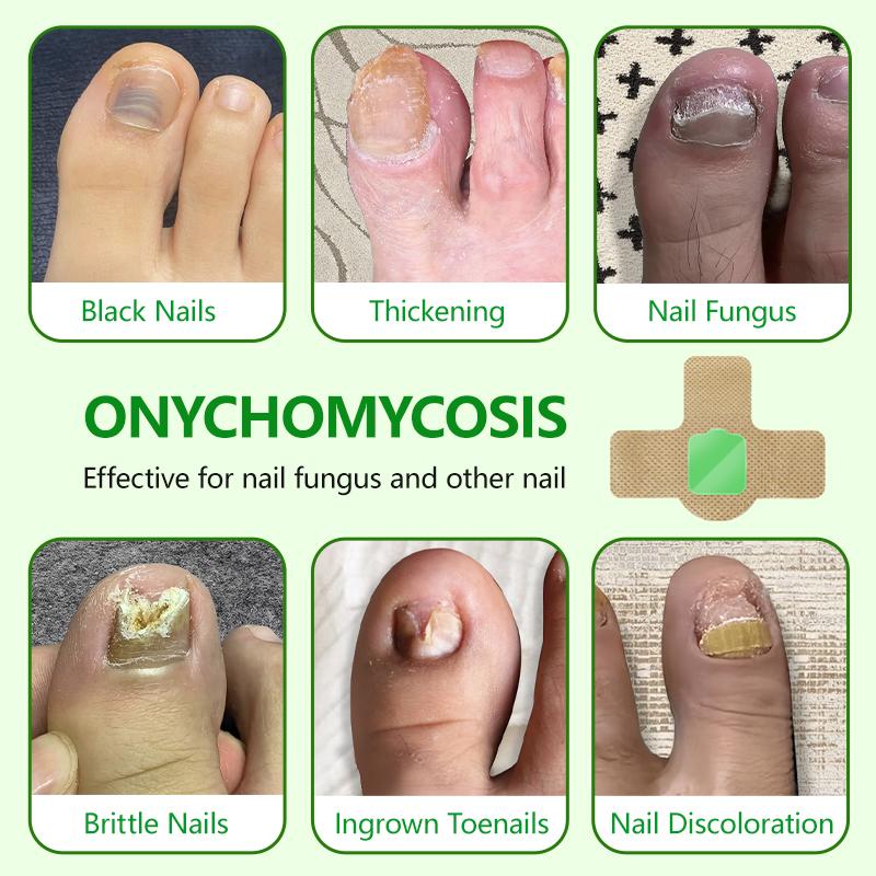 Lansiyi Fungal Nail Patches, 21pcs/box Nail Health CarePatches, Nail Fungus Care Patches with 5 Herbs for Solving Fungal Nails and Other Nail Problems, NailSupplies, Daily Care Nails Kit Set, Nail Tech Supplies,Self Care Tools Matte Japanese Lansiyi Fungal Nail Patches, 21pcs/box Nail Health CarePatches, Nail Fungus Care Patches with 5 Herbs for Solving Fungal Nails and Other Nail Problems, NailSupplies, Daily Care Nails Kit Set, Nail Tech Supplies,Self Care Tools Matte Japanese