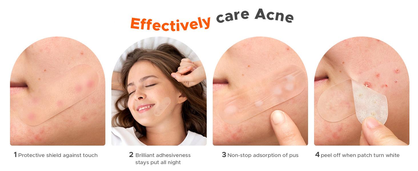 TKTK Hydrocolloid Bandages, 45 x 45 mm Large Pimple Patches for Face, XL Acne Patches for Body, Back, Forehead, Cheek Zit Breakouts, Big Hydrocolloid Patch (Square, Strip, Dot 5 Sizes 120 Count)