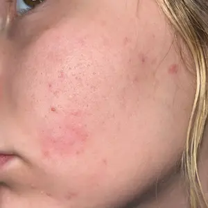 Product Review of Lion Pair Acne Cream Acne Treatment Pimples Removal Cream Pair Acne Creamy Foam Facial Wash Gentle Antibacterial from ♡**♡