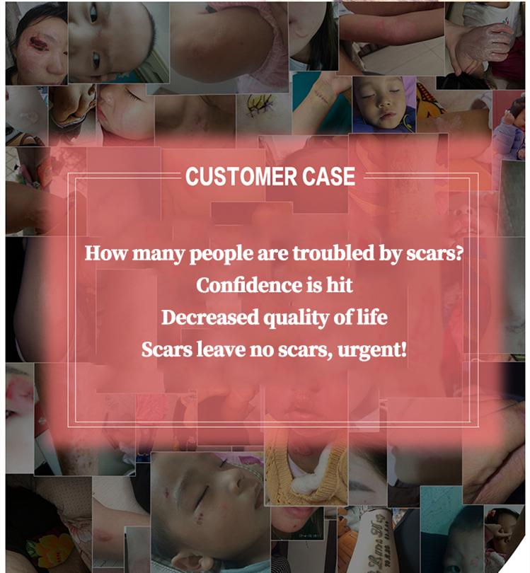Professional and powerful scar removal gel - suitable for scar removal treatment of post-operative scars, caesarean section scars, keloids, burns, acne, etc.-A Professional and powerful scar removal gel - suitable for scar removal treatment of post-operative scars, caesarean section scars, keloids, burns, acne, etc.-A