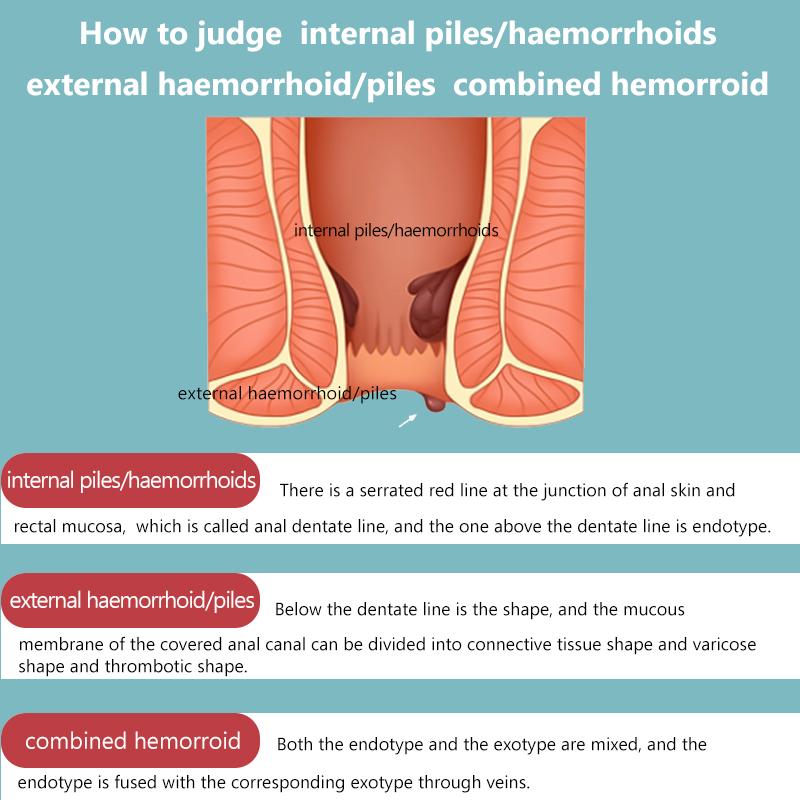 Hemorrhoid and Anal Fissure Ointment, Hemorrhoid Treatment, Fast Relief from Swelling, Pain, Itching, Burning (20g) Body Cream relief discomfort Natural massage crema