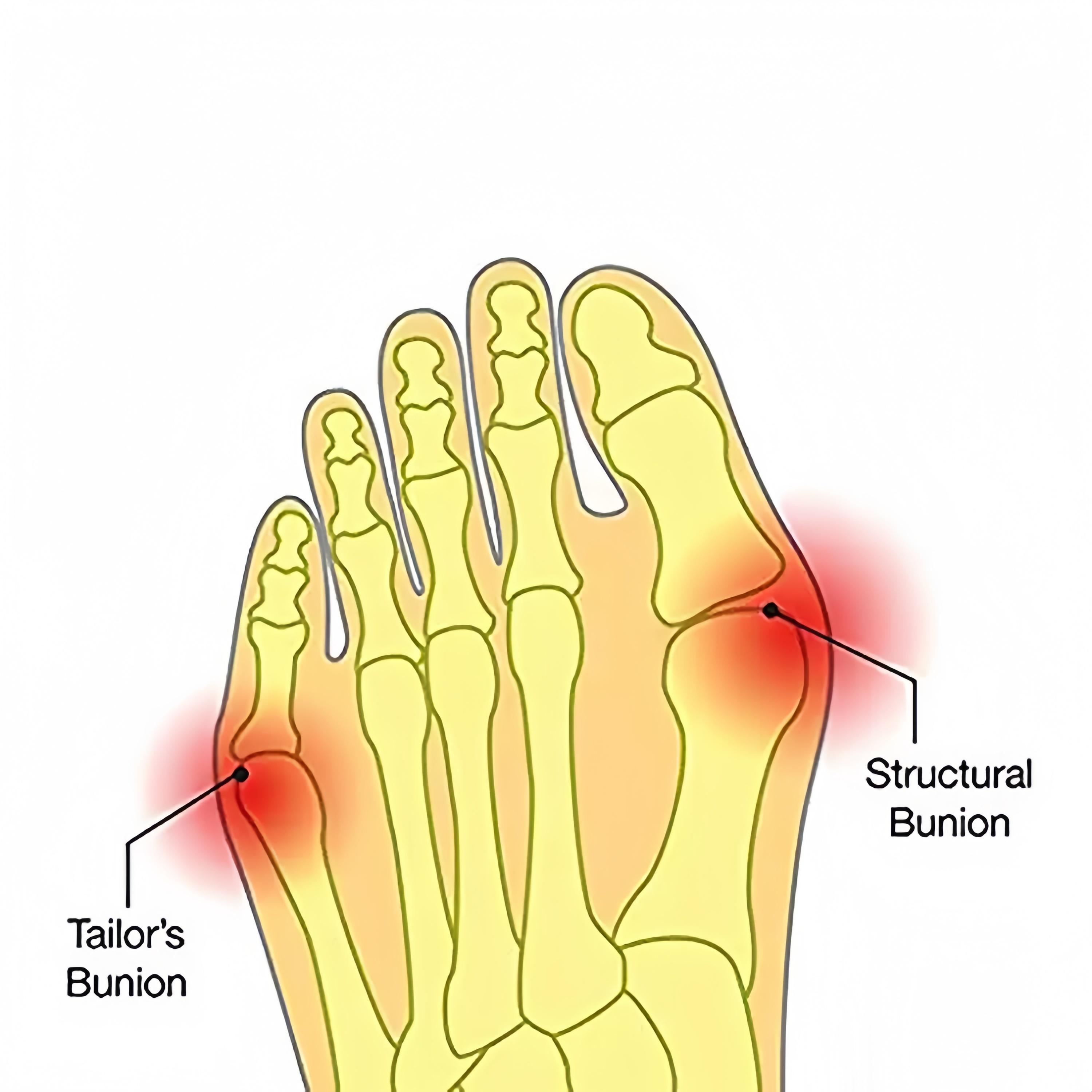 Bunion Relief Set - Breathable Minimalist Design Water Shoes with Wide Toe Box, Anti-Slip Rugged Outsole, Bunion Correction Kit for Hallux Valgus Pain & All-Scenario Use