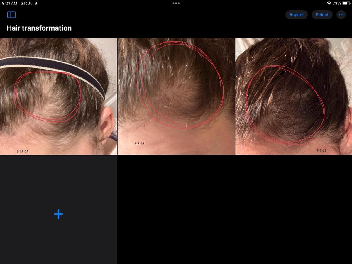 Item: 【Buy 1 Get 1 Free】HAIR LOSS TREATMENT