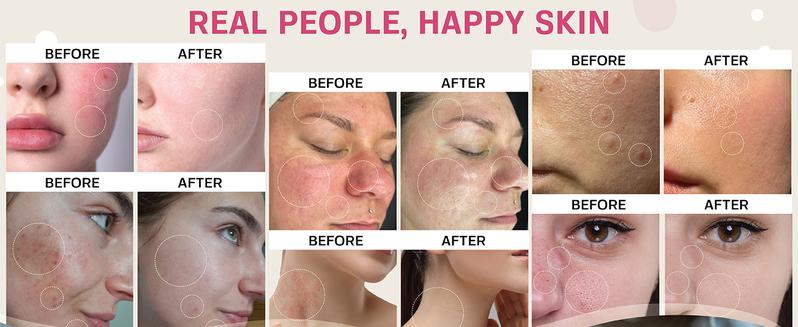 Base Laboratories Hypochlorous Acid Spray & Wipes Bundle - 75 Wipes & 8oz Spray for Acne Eczema Piercings & Irritations Fast Relief for Daily Use Base Laboratories Hypochlorous Acid Spray & Wipes Bundle - 75 Wipes & 8oz Spray for Acne Eczema Piercings & Irritations Fast Relief for Daily Use