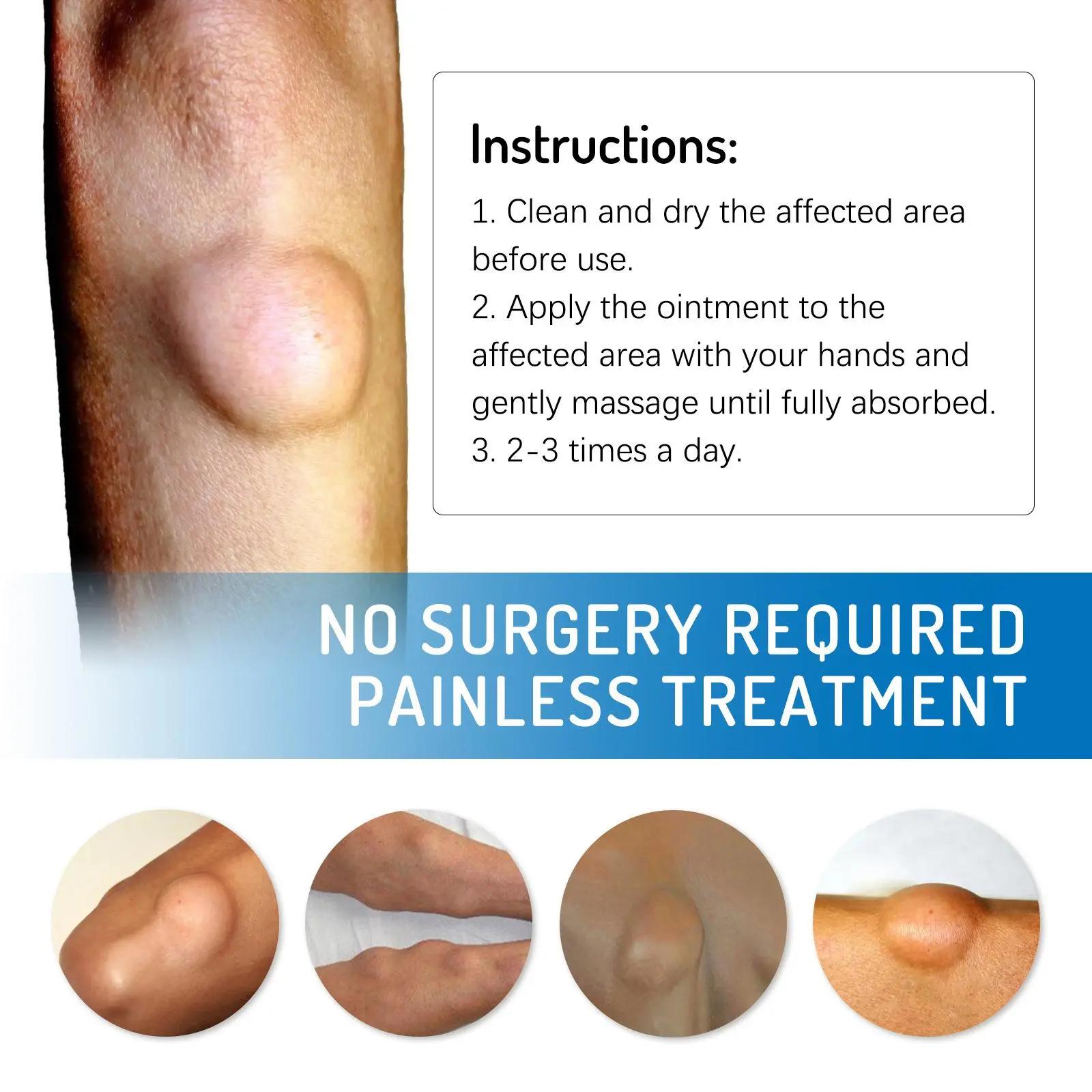 Soothing Body Cream for Subcutaneous Lumps: A lightweight, non-greasy cream specially formulated to relieve subcutaneous lumps caused by lipomas.