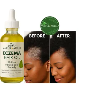 Eczema Hair Oil Haitian Natural Leaf Remedy 100% Natural Gentle for Kids & Adults Soothes Scalp Promotes Growth Treatment Healthcare Solution Healthy Essential Traditional - Haircare