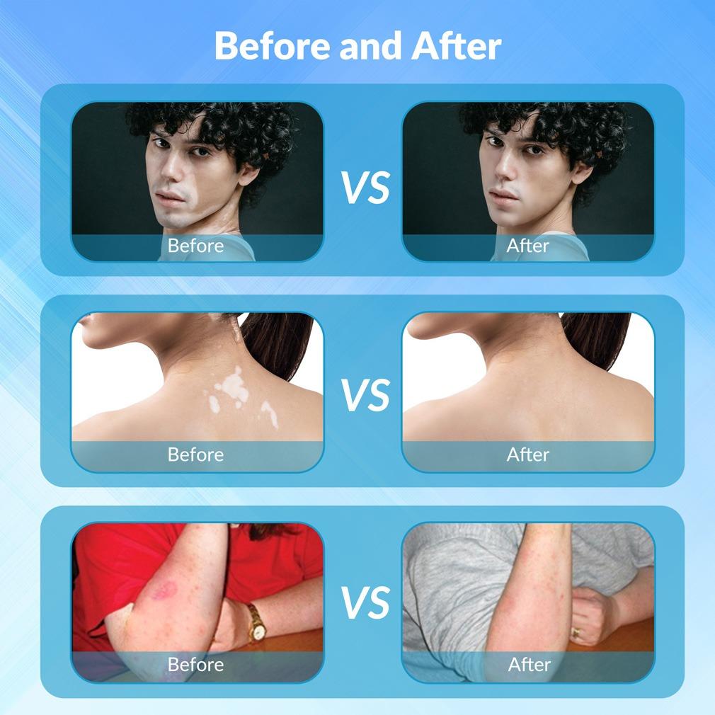 ZJZK 6 Diodes 308nm UVB Excimer Phototherapy Device, 20mW/cm² High Energy Density, Handheld Blue Light Skin Treatment, Targeted Therapy for Vitiligo, Psoriasis, Eczema, Atopic Dermatitis, Portable Home Use for Skin Disorders