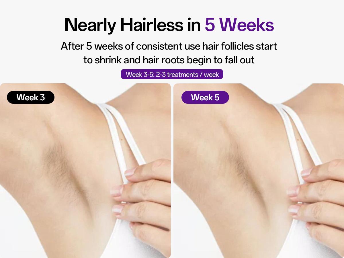 Laser Hair Removal Device for Women & Men, At-Home Painless IPL Laser Hair Remover with 40°F Ice-Cooling Contact, Long-Lasting Lazer Hair Removal for Face, Legs, Armpits, Bikini Line