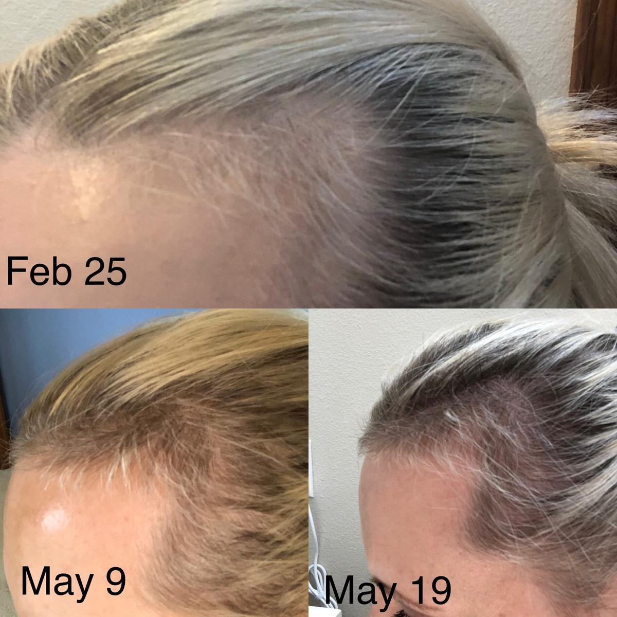 Item: 【Buy 1 Get 1 Free】HAIR LOSS TREATMENT