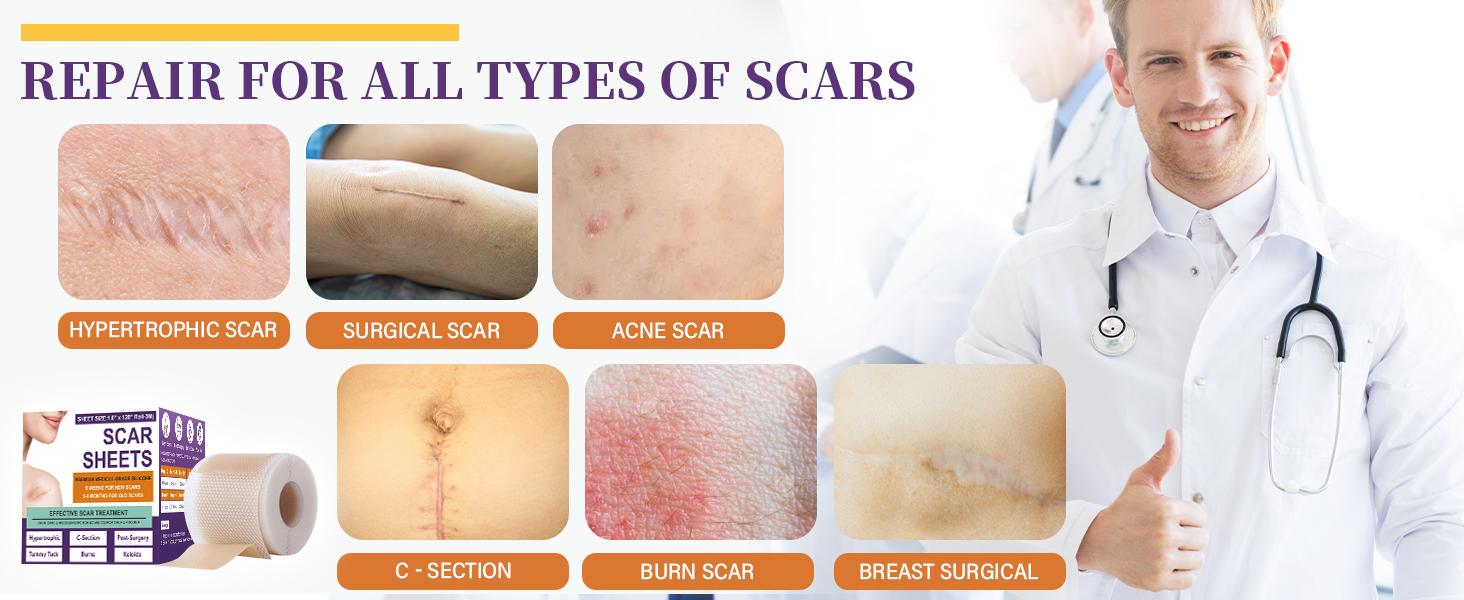 Silicone Scar Sheets,Silicone Scar Tape,Silicone Scar Removal Strips for Surgical,C-Section,Tummy Tuck,Keloid Scars (1.6"X 59" Roll-1.5M) Keloid Bump Removal