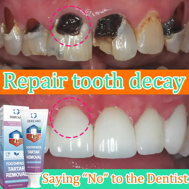 ZKRICARO Hydroxyapatite Anti-Cavity Toothpaste, Enamel Repair & Micro‑Crack Restoration, Tartar & Plaque Remover, Stain Prevention for Coffee & Food, 12hr Fresh Breath, Food-Grade Safe, Gentle Formula for Kids & Adults, Family Oral Care