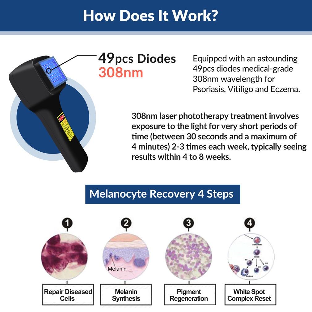 ZJZK 308nm Excimer Phototherapy Device with 49 Diodes, Blue Light Therapy for Vitiligo, Psoriasis, Eczema, Atopic Dermatitis, Fungal Skin Disease, Hypopigmentation, Safe Targeted Home Use, Fast Recovery, Prevent Recurrence, Portable Handheld