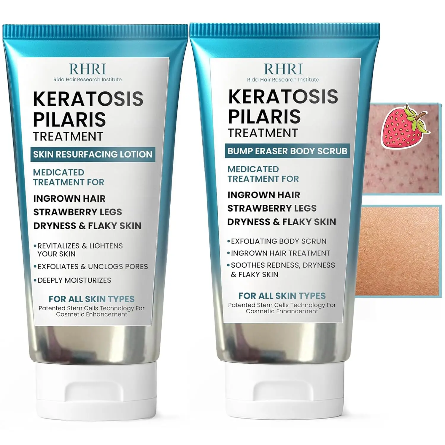 Keratosis Pilaris Lotion + Scrub