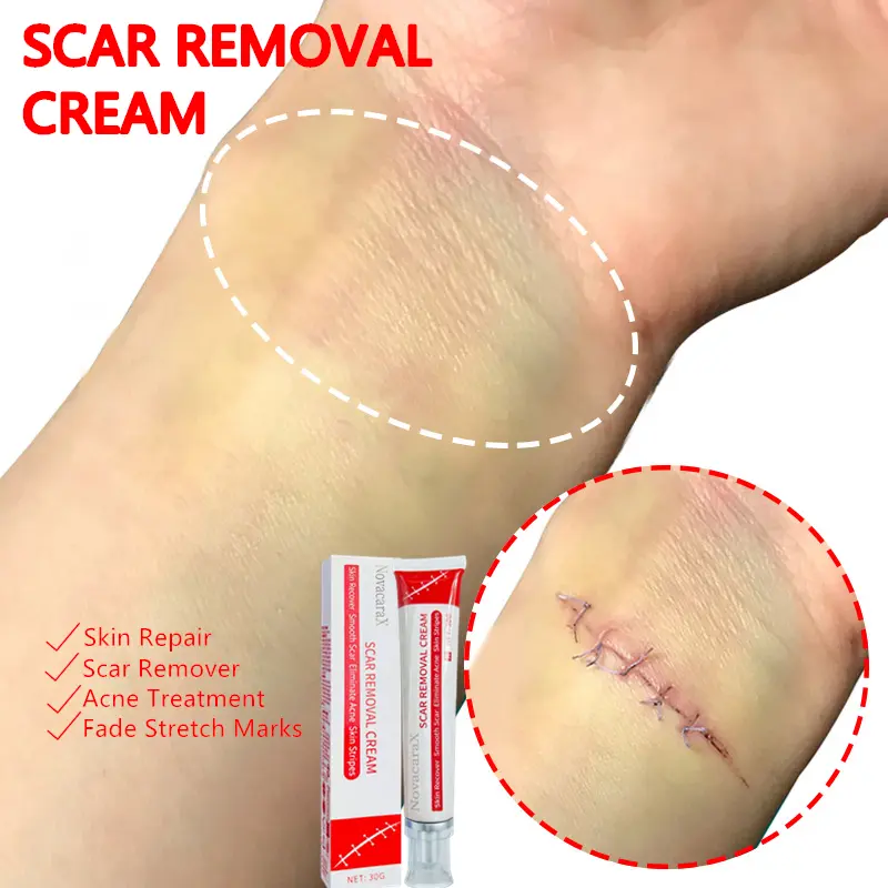 Professional and powerful scar removal gel - suitable for scar removal treatment of post-operative scars, caesarean section scars, keloids, burns, acne, etc.