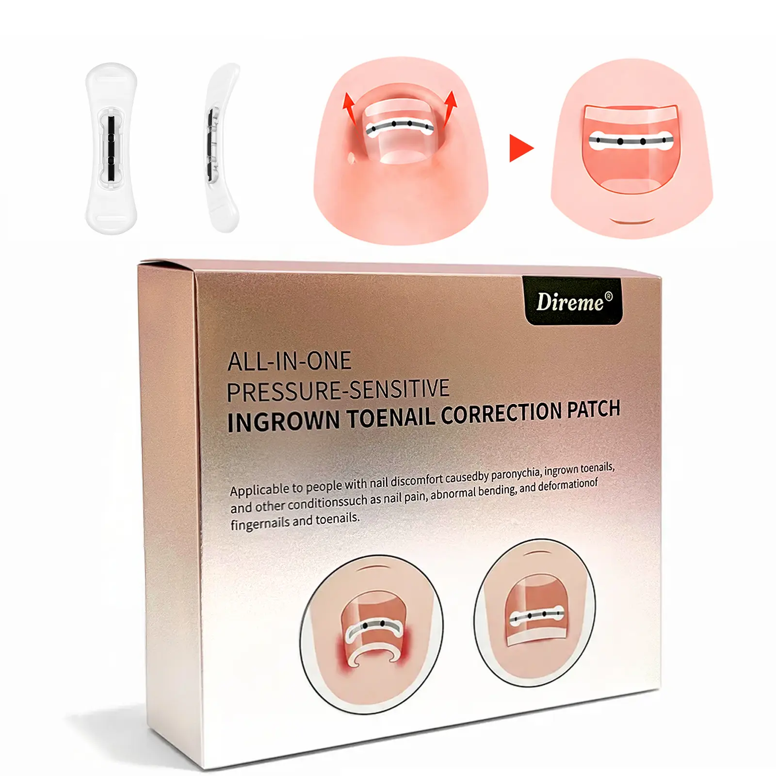 Titanium Alloy Ingrown Toenail Treatment, Quick Relief, Ingrown Toenail Removal Kit， Professional Ingrown Toenail Corrector,  All Nail Types Manicure Nail Products Cutics