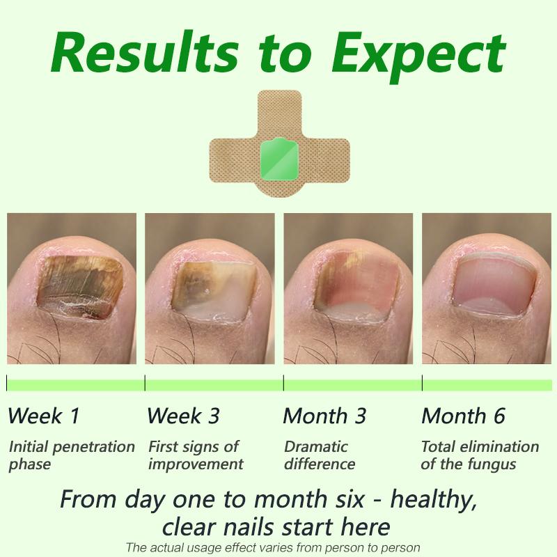 Lansiyi Fungal Nail Patches, 21pcs/box Nail Health CarePatches, Nail Fungus Care Patches with 5 Herbs for Solving Fungal Nails and Other Nail Problems, NailSupplies, Daily Care Nails Kit Set, Nail Tech Supplies,Self Care Tools Matte Japanese Lansiyi Fungal Nail Patches, 21pcs/box Nail Health CarePatches, Nail Fungus Care Patches with 5 Herbs for Solving Fungal Nails and Other Nail Problems, NailSupplies, Daily Care Nails Kit Set, Nail Tech Supplies,Self Care Tools Matte Japanese